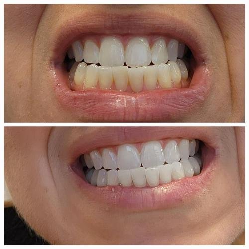 OliVera - V34 Whitening Strips